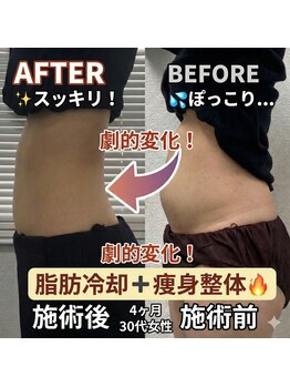 前田鍼灸接骨院/脂肪冷却＋痩身整体