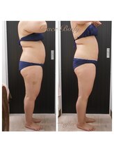 痩身脱毛専門店 グレイスボディ MEGAドンキホーテ三郷店(Gracebody)/◆痩身　症例写真