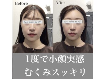 ハリサロンドオフ 心斎橋店(hari salon de off)/お顔全体のむくみがスッキリ！