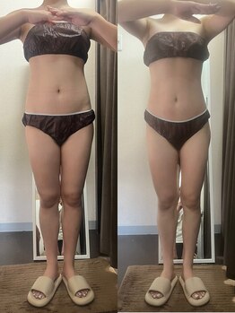 サロンドココ(Salon de COCO)/ハイパーナイフ全身痩身