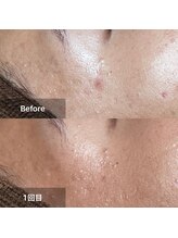 ネオオアシス トウキョウ(ネオOASIS TOKYO)/ハーブピーリング（剥離あり）