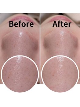 マルヤマサロン(MARUYAMA SALON)/毛穴集中ケア