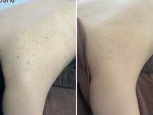 エミルカ 神戸三宮(EMILUCA)/肩のニキビケア♪