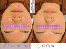 シエスタ(siesta)/-彩-ハーブピーリング