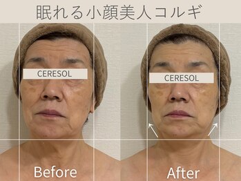 セレソル(CERESOL)/〈70代女性〉施術10回での効果＊