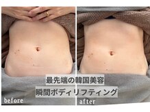 ハーブピーリング/マイクロウェーブ/韓国肌管理