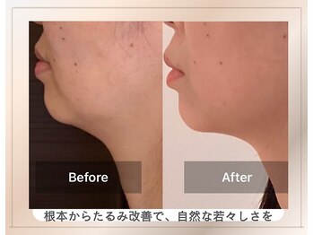 アトリエドゥアージュ(Atelier de age)の写真/人気の韓流美肌へ！敏感肌の方も◎ダウンタイムなし。もちもちでハリのあるあなた本来の美肌へ。
