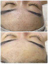 美肌脱毛専門店 パールプラス 大在店/全身脱毛＋泡エステ