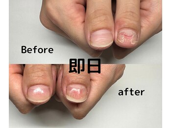 保育士、看護師さんOK!自爪風