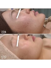 シス(SiS.)/ハーブピーリング5回目