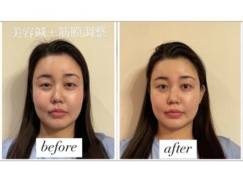 ヤマモト 表参道院(YAMAMOTO)/美容鍼＋全身整体