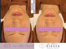 シエスタ(siesta)/-彩-ハーブピーリング