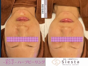 シエスタ(siesta)/-彩-ハーブピーリング