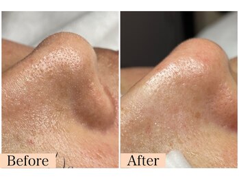 シャイニングビューティー 表参道(Shining Beauty)/ハイドラ毛穴洗浄/毛穴レス