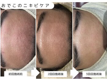 サロンベース(salon BASE)/ハーブピーリングでニキビケア