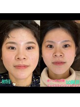 日進町整体院/20代女性　初回と１０回目の比較