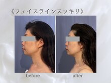 ジュプン 長崎/小顔筋膜のお客様★