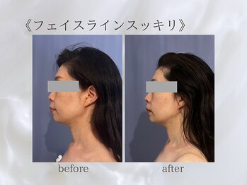 ジュプン 長崎/小顔筋膜のお客様★