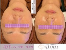 シエスタ(siesta)/-彩-ハーブピーリング