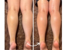 トータルビューティー ココ(Total Beauty CoCo)/高周波&吸引マッサージ20分1回目