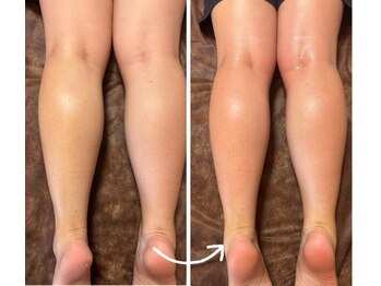 トータルビューティー ココ(Total Beauty CoCo)/高周波&吸引マッサージ20分1回目