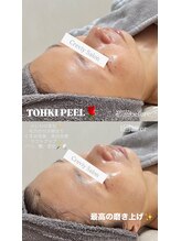 クレヴィー(Creviy)/陶肌ピール1回