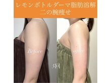 レシェルサロン(Lechelle Salon)/レモンボトル　二の腕