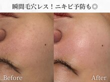 芯美 恵比寿店(shinbi)/瞬間毛穴レス！ニキビ予防にも◎