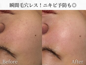 芯美 恵比寿店(shinbi)/瞬間毛穴レス！ニキビ予防にも◎
