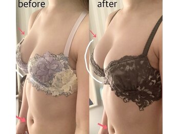 ブレスト 新宿本店(Breast)/《5回目》30代　（バストアップ)