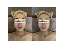 9割の方がリピート。ダウンタイムのない眠れる3D小顔矯正