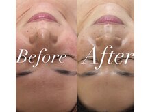 マヤヒメ(mayahime)/REVIハーブピーリング