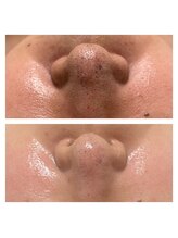 ホズリル(Hozril)/毛穴黒ずみ除去