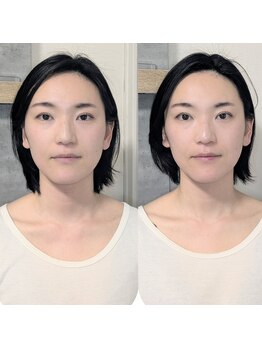 ワヒネ(WAHINE)/小顔矯正の実感