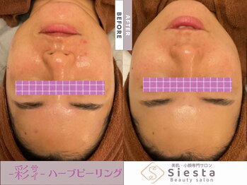 シエスタ(siesta)/-彩-ハーブピーリング