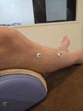 ムラサキ鍼灸治療院(MURASAKI鍼灸治療院)/足が浮腫む、張っている方に