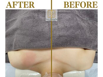 ヴェールブランシュ 町田(Vert Blanche)/#ブライダルエステ#痩身#鎖骨