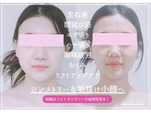 トゥインクル 麻布(twinkle)/港区/麻布十番/南麻布/小顔矯正