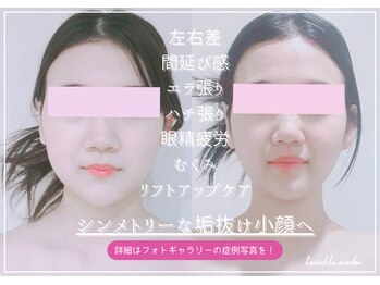 トゥインクル 麻布(twinkle)/港区/麻布十番/南麻布/小顔矯正