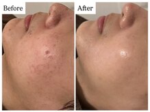 ベル 恵比寿(Belle)の雰囲気(敏感肌、赤みにもREVIハーブピーリング☆ニキビ・毛穴ケアにも◎)