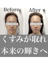 ハリサロンドオフ 心斎橋店(hari salon de off)/くすみ改善にばっちり☆