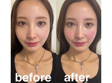 マホロバ(mahoroba)/気になるエラ張りに美容鍼