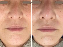 カプリス(CAPRiCE)/BBLフェイシャル