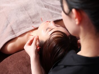 シー バイ カリスタ 新宿南口店(C by CALISTA)/美容鍼でフェイスラインすっきり