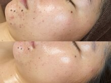 ビジュープラス 広島店(Bijou+)/【20代/ニキビ肌】