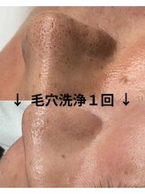 バディーズ(BUDDieS)/メンズ専門ハイドラ毛穴洗浄