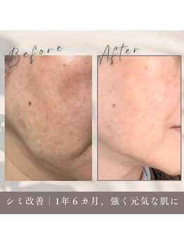 エルブラン(Herb ame)/たるみ改善/肌質/シミ/法令線