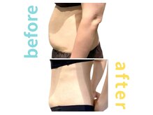 シエル(Ciel)/脂肪冷却