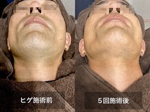 リリー(RILY)の雰囲気（1番人気のヒゲ脱毛♪髭剃り不要に最短で導きます!メンズ脱毛/VIO）