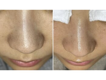 アイスリー(i III)/皮脂の分泌もコントロール★